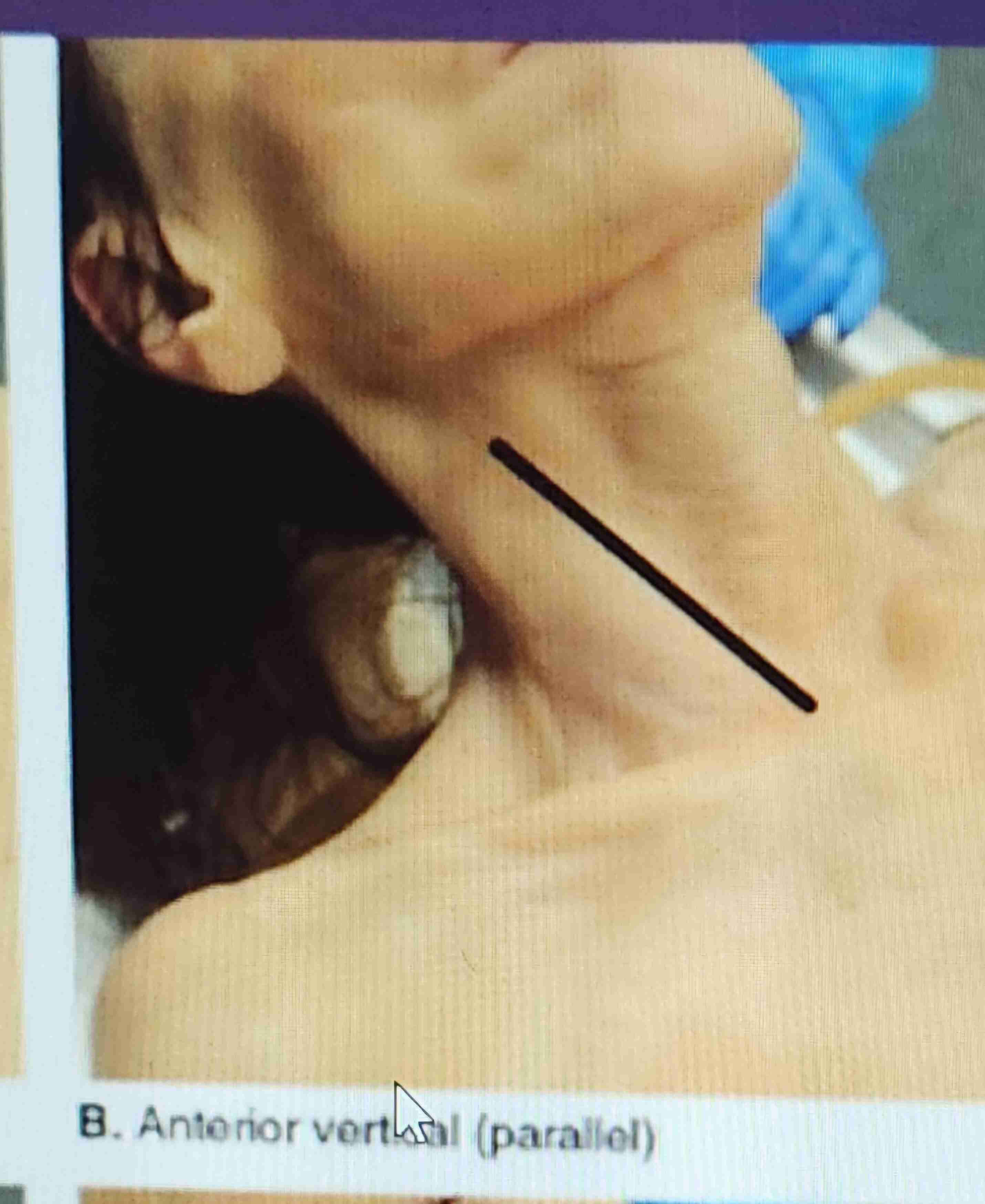 <p>Anterior verticle (parallel)</p>