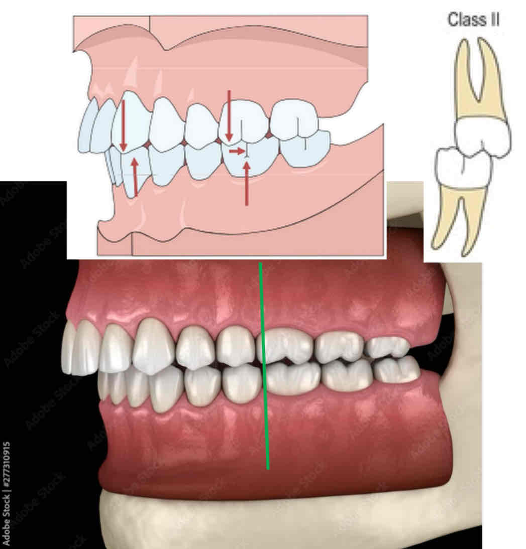 <p>what is class II molar occlusion (less common type)?</p>