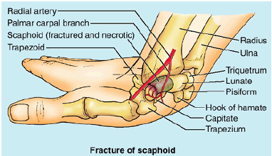 fall onto palm w/ abducted; pain on lateral side exten abduct; deep tenderness in anatomical snuffbox; proximal avn