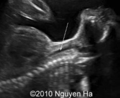 <p>What structure is seen at the arrow?</p>