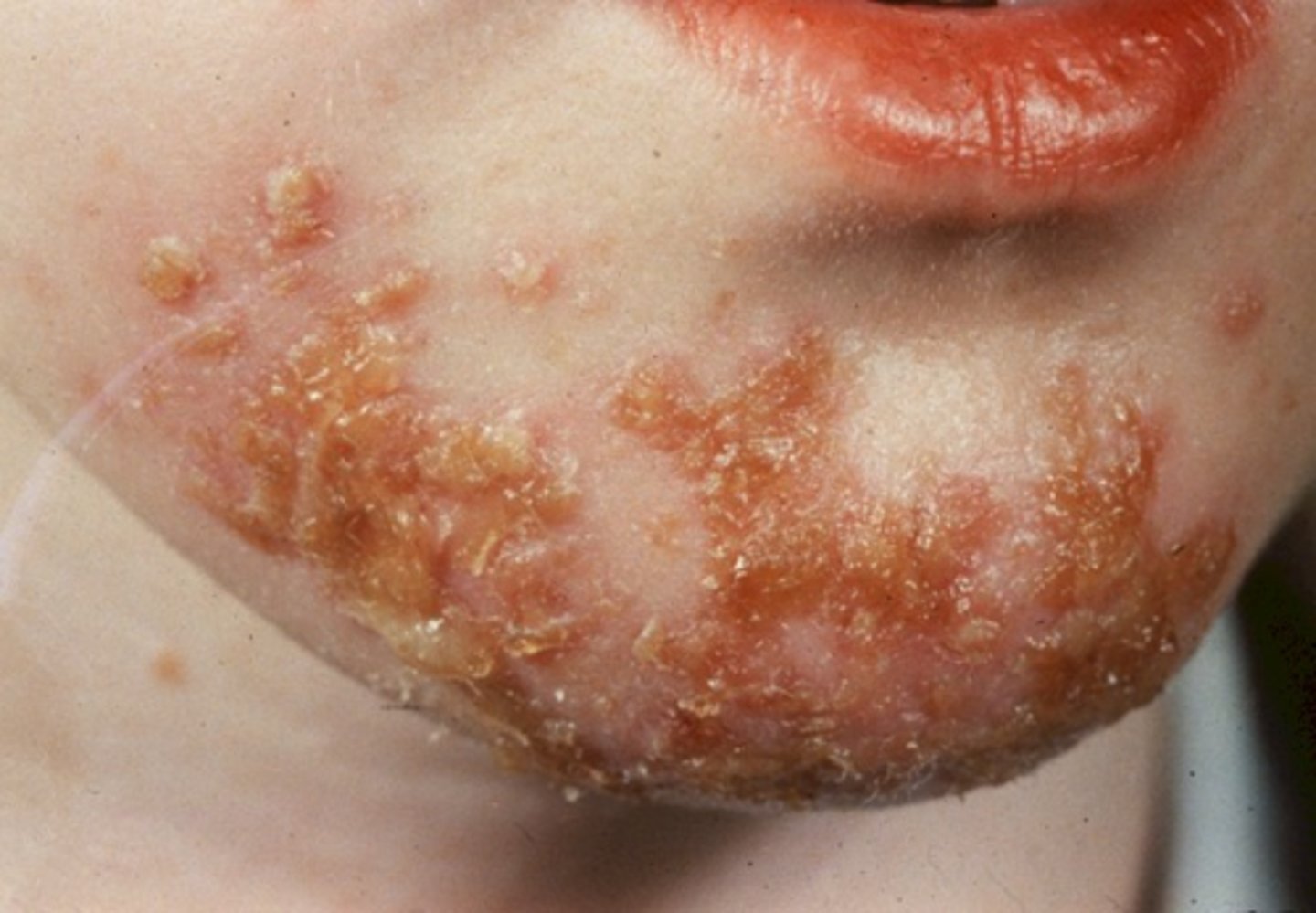 <p>non-bullous: focal, vesicular pustular lesions with a thick honey colored crust with a "stuck on" appearance</p>