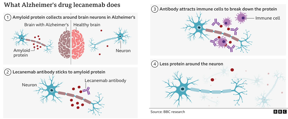 <p>Alzheimer’s (technically mild cognitive improvement or mild dementia) </p>