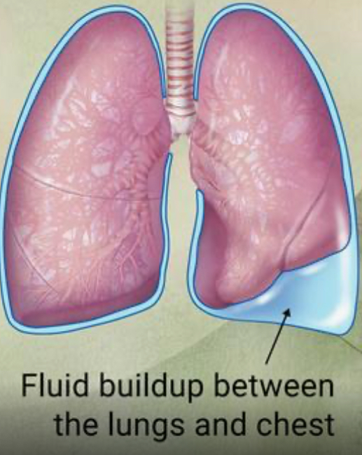 <p><span style="color: rgb(237, 241, 241)">A buildup of fluid between the tissues that line the lungs and the chest</span></p><ul><li><p><br><span style="color: rgb(237, 241, 241)">Fluid can accumulate around the lungs due to poor pumping by the heart or by inflammation.</span></p></li></ul>