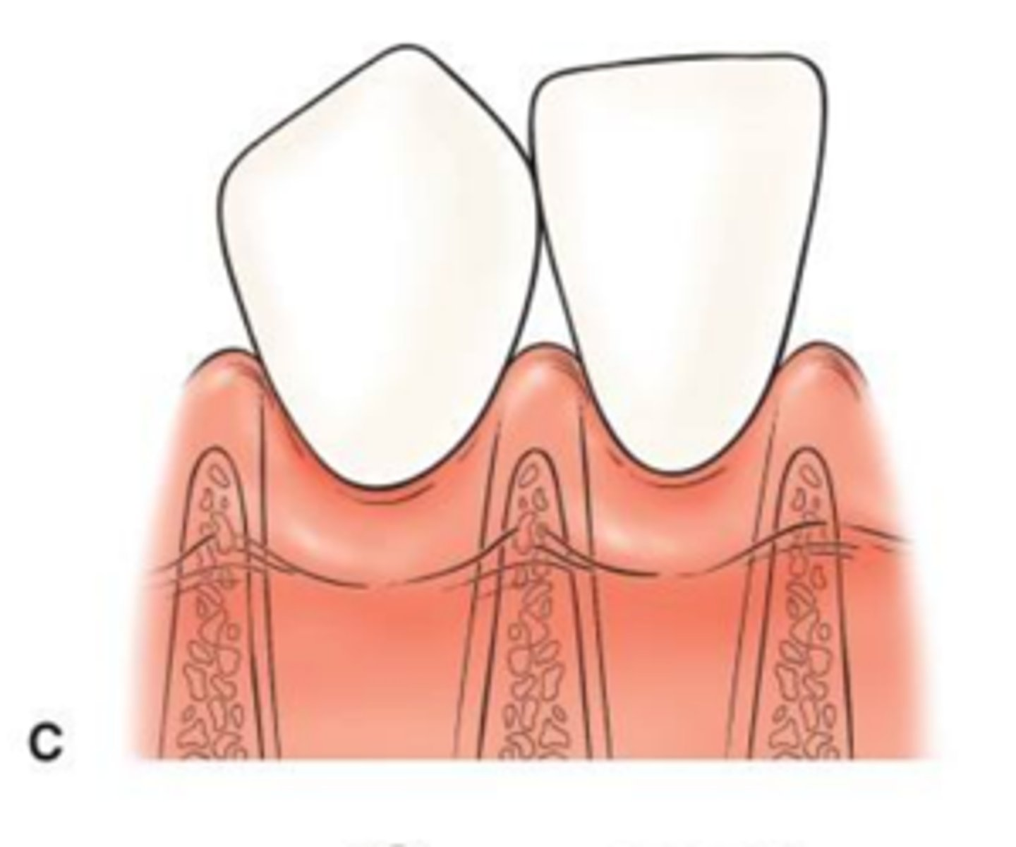 <p>The tip of the interdental papilla is at or apical to the interproximal CEJ, but coronal to the height of the facial CEJ. Papilla is partially missing</p>