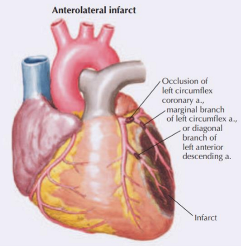 <p>Lateral wall of the left ventricle</p><p>The posterior wall (if the left is dominant)</p>