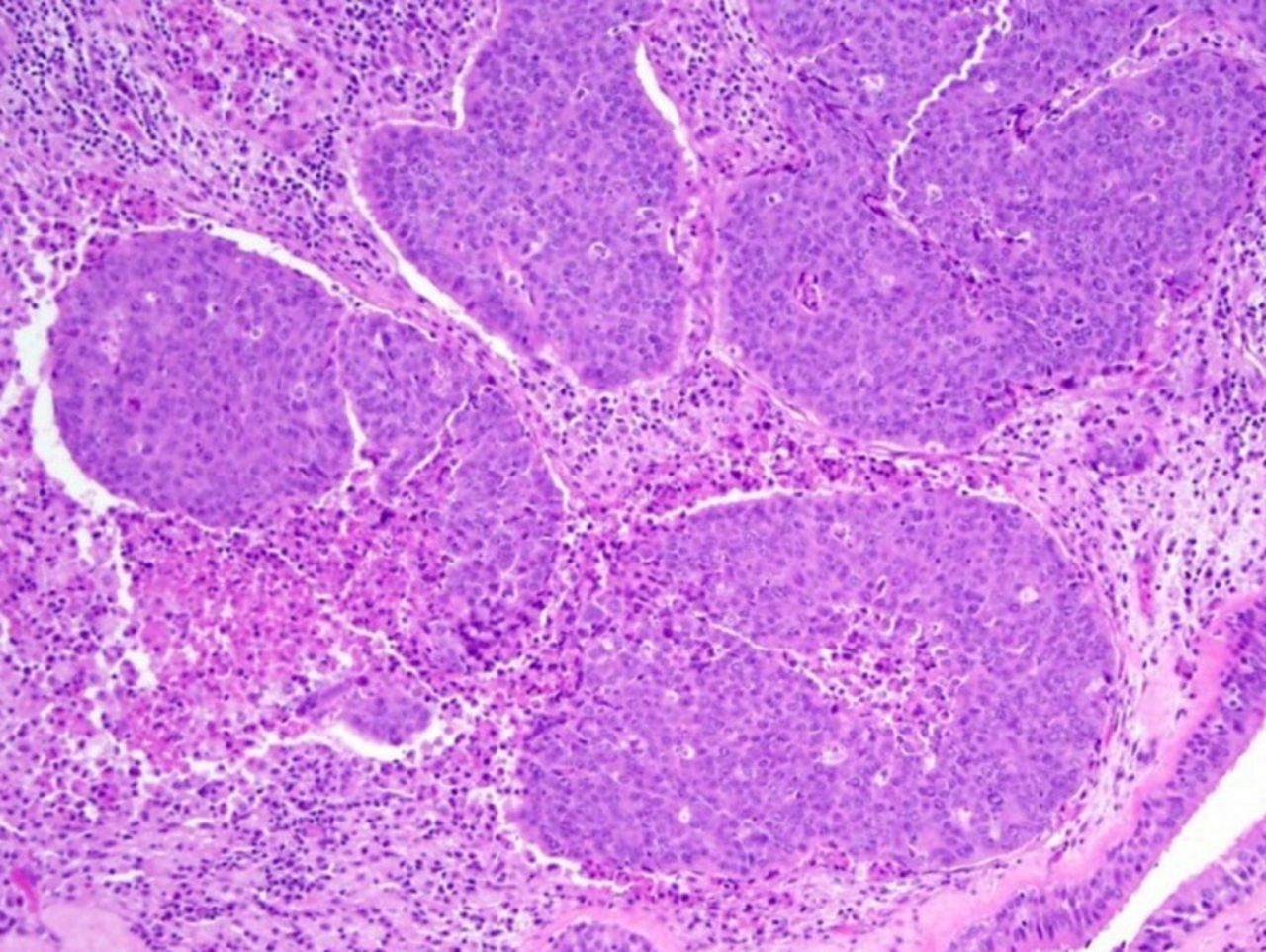 <p>Patient de 30 ans, masse de la cavité nasale </p><p>1) Diagnostic</p><p>2) Localisations</p><p>3) Etiologie</p><p>4) Histologie </p><p>5) IHC </p>
