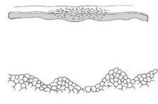 <p>Lesión plana circunscrita con alteración en el color de la piel</p><ul><li><p>Hemorragias, lentigo (aumenta pigmento), vitiligo (disminuye pigmento)</p></li></ul><p></p>