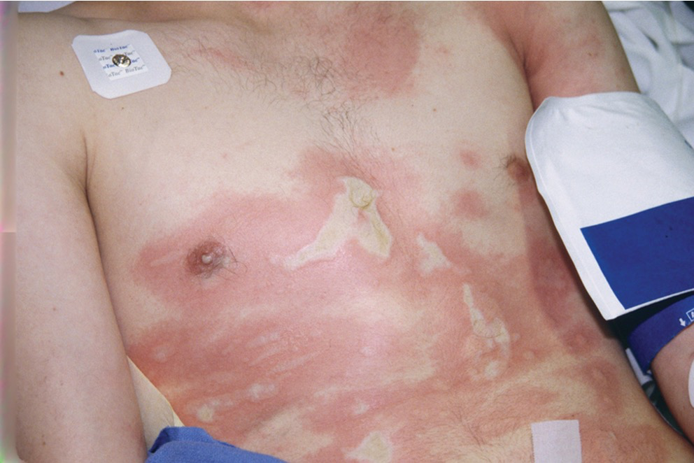 <ul><li><p><span>Epidermis burned through, dermis damaged</span></p></li><li><p><span>Deep, intense pain (Why)</span></p></li><li><p><span>Noticeable reddening</span></p></li><li><p><span>Blisters and mottling</span></p></li></ul><img src="https://knowt-user-attachments.s3.amazonaws.com/be2c9f5d-2944-4f1a-a373-9bafb5d9817f.png" data-width="75%" data-align="center" alt="knowt flashcard image"><p></p>