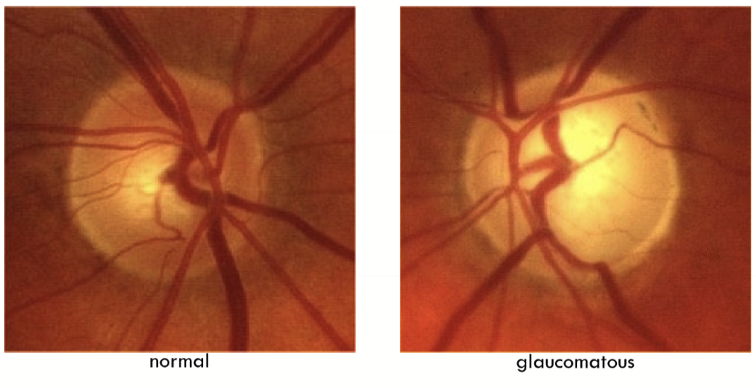 <p>Optic neuropathy that is typically characterized by optic nerve damage </p>