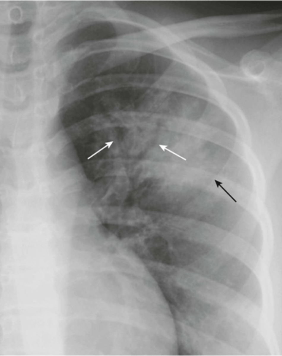 <p>-air bronchograms</p><p>visible airways inside a consolidated lung.</p>