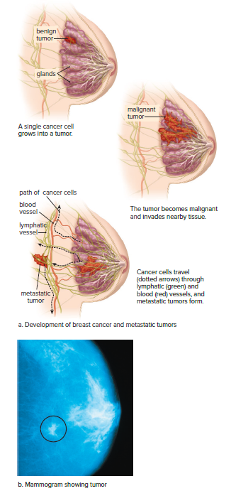 Development of breast cancer.