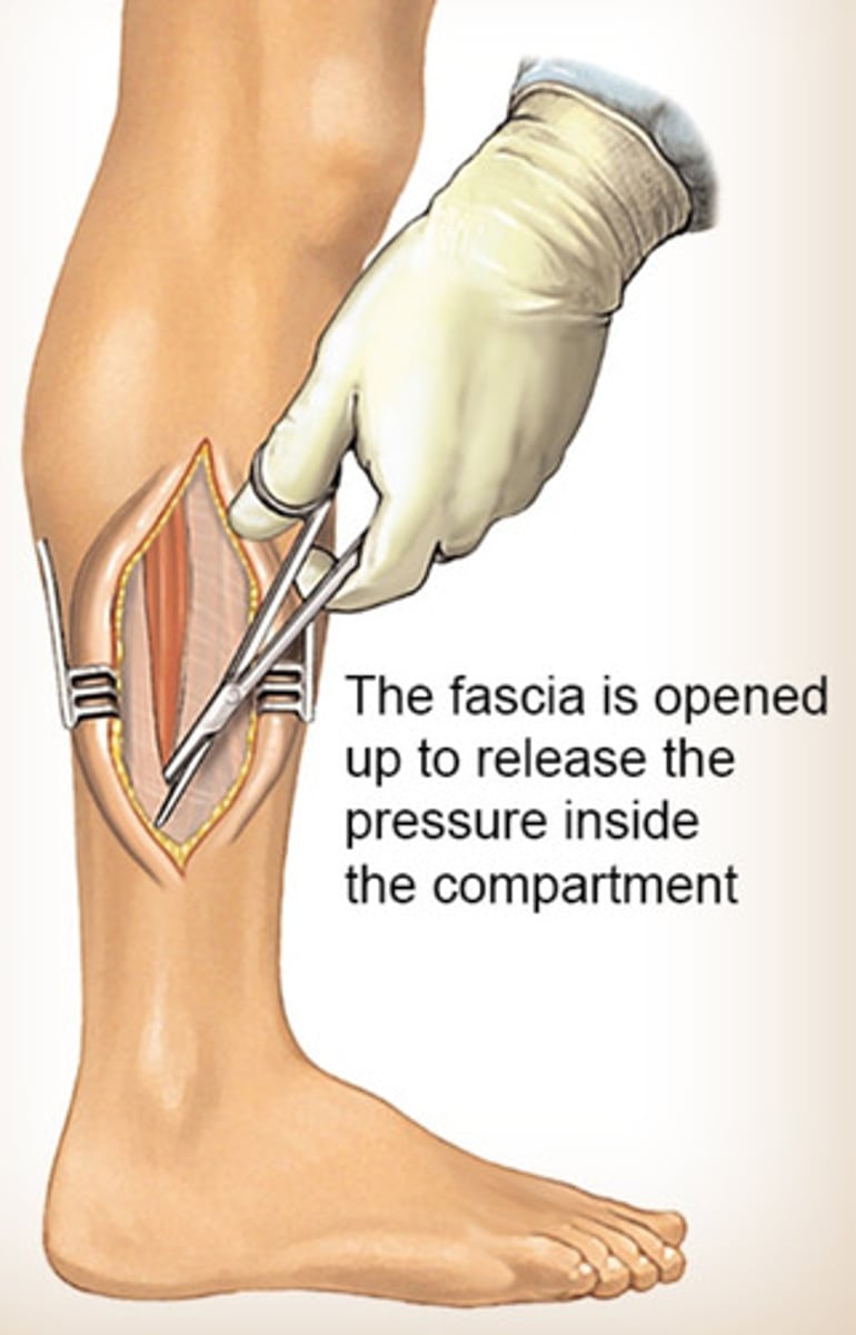 <p>relieve pressure immediately!!</p><p>- elevate</p><p>- relieve cast/dressing ('bivalve' cast => spilt the cast open to relieve pressure)</p><p>- fasciotomy => slicing fascia open surgically to relieve pressure</p>