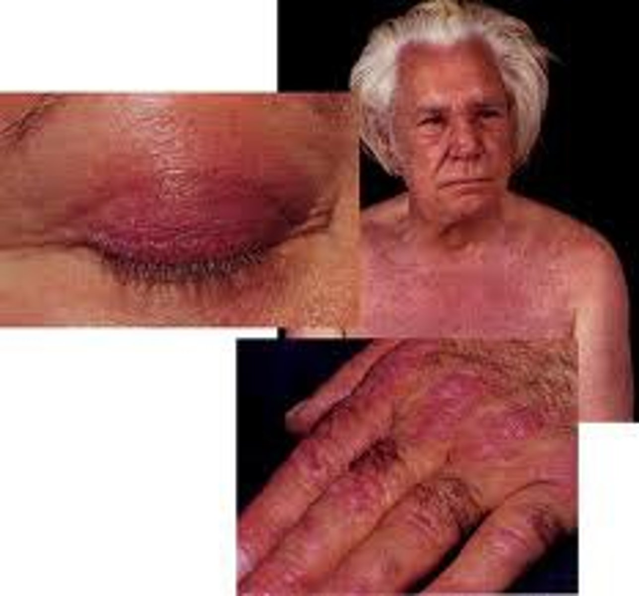 <p>Idiopathic inflammatory muscle disease </p><p>Dermatomyositis = polymyositis + heliotrope rash (purple discolorations and edema of eyelids)</p><p>Gottron papules: erythematous rash on extensor surfaces of fingers, elbows, knees </p><p>Muscle: gradual and progressive painless symmetrical proximal upper and lower extremity muscle weakness (raising from chair, combing hair), polyarthritis</p><p>Elevated muscle enzymes </p>