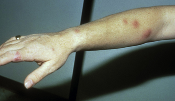 <p>The yeast infects <strong>subcutaneous tissue</strong>, forming a <strong>lesion that ulcerates</strong> and may <strong>disseminate along lymphatic vessels</strong>.</p>