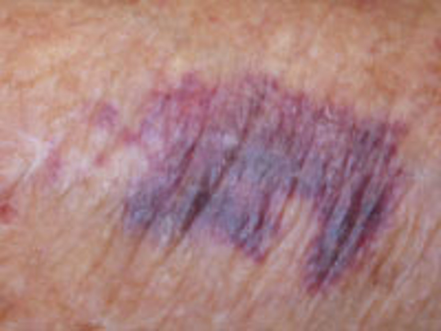<p>Purpura is a condition of red or purple discolored spots on the skin that do not blanch on applying pressure. The spots are caused by bleeding underneath the skin usually secondary to vasculitis or dietary deficiency of vitamin C. They measure 0.3-1 cm, whereas petechiae measure less than 3 mm, and ecchymoses greater than 1 cm. this purplish discoloration of the skin is often a sign of a life-threatening infection.</p>