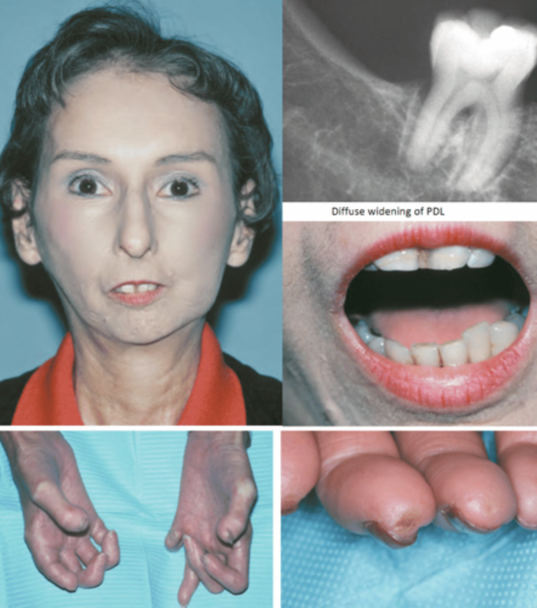 <p>-microstomia due to collagen deposition on perioral tissues</p><p>-furrows radiating from mouth - "purse string" </p><p>-loss of attached gingiva</p><p>-dysphagia</p><p>-firm hypomobile tongue</p><p>-xerostomia</p>