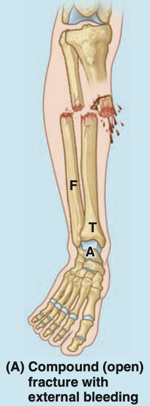 <p>one in which the skin is perforated by the bone and blood vessels are torn</p>