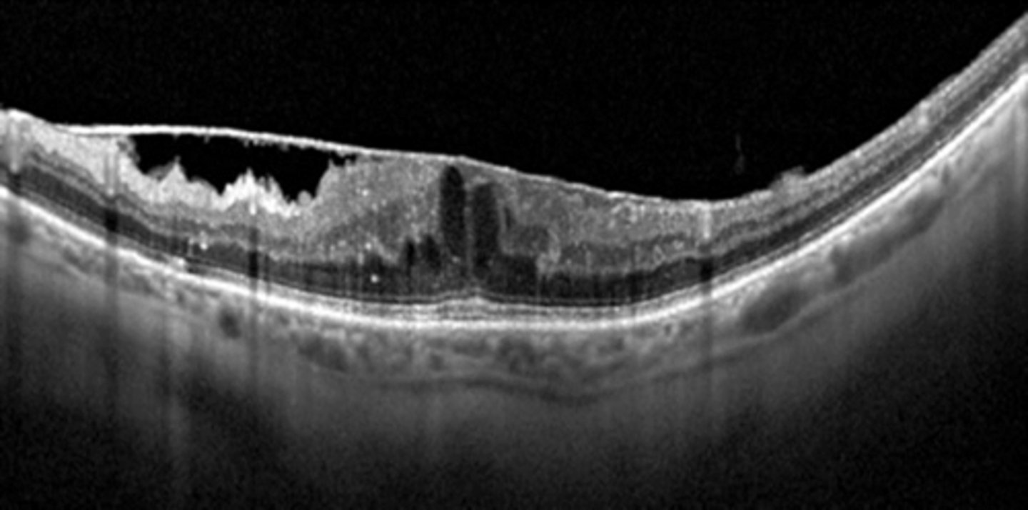 <p>macular pucker = pulling causes macular edema/cystic spaces</p>