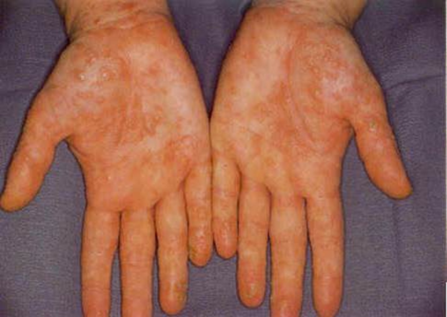 <p>dyshidrotic eczema</p>
