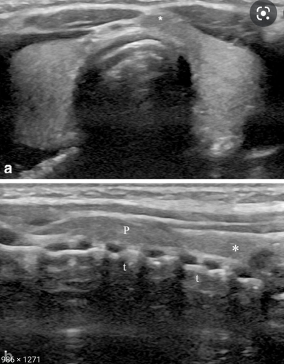 <p>-Third lobe arising from the superior portion of the isthmus</p><p>-Ascends to the level of the hyoid bone</p><p>-Appears in 10-40% of patients</p><p>-Begins to atrophy in adulthood</p><p>-Appears isoechoic to the normal thyroid gland</p>