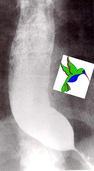 <p>What are the classic barium swallow signs of achalasia?</p>
