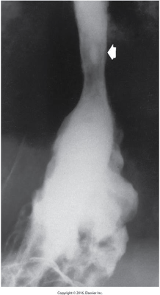<p>What is esophagitis "GERD - gastroesophageal reflux disease"?</p>