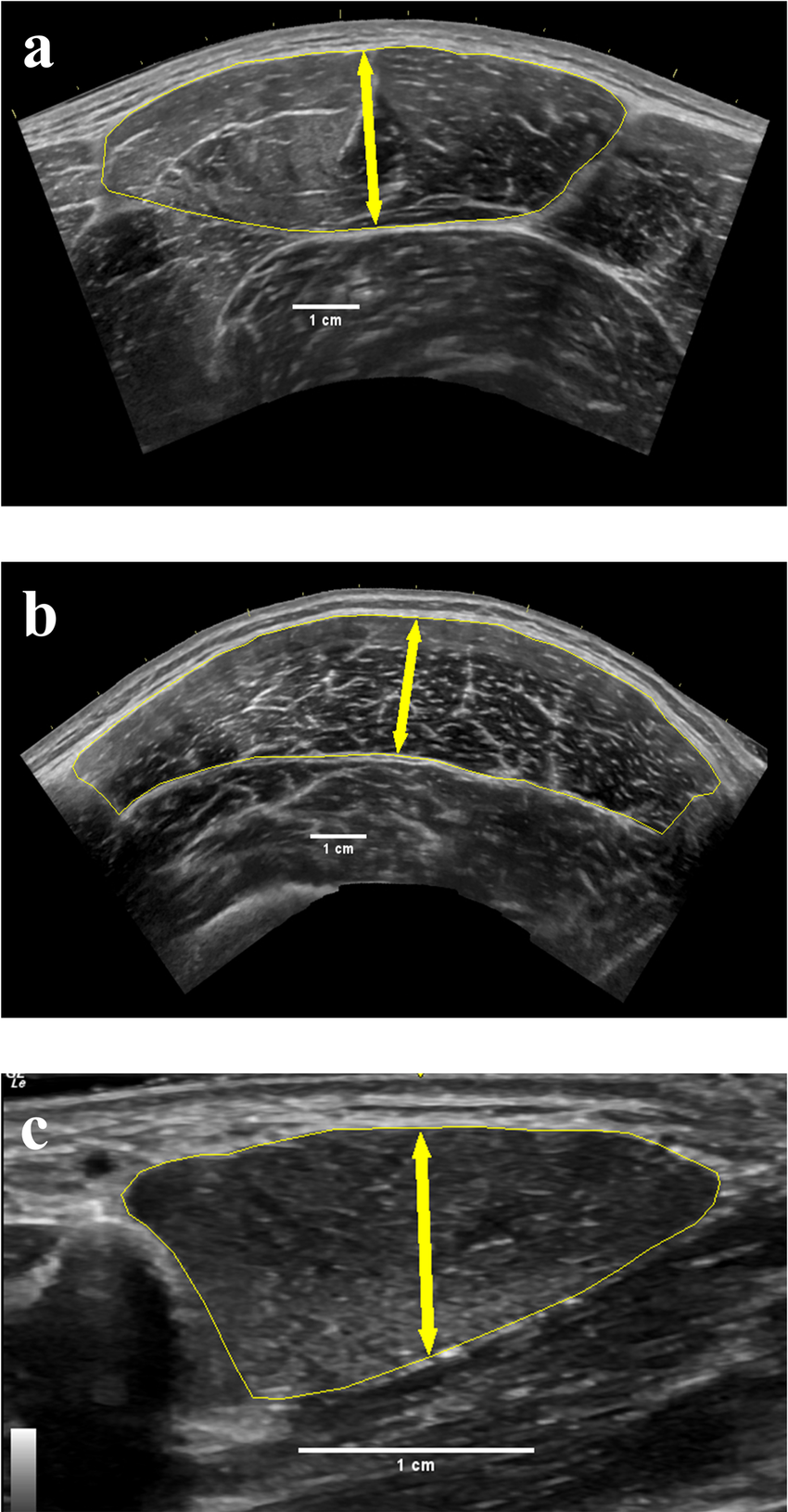 <p>Hypoechoic fiber bundles interspersed with hyperechoic stromal connective tissue</p>
