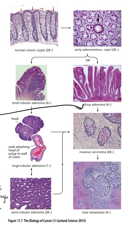 <ul><li><p class="Paragraph WhiteSpaceCollapse SCXP136397387 BCX0" style="text-align: left"><span><strong>Top right </strong>– cross section through crypts – arrow marks an adenomatous crypt; others normal​</span></p></li><li><p class="Paragraph WhiteSpaceCollapse SCXP136397387 BCX0" style="text-align: left"><span>Cells of the abnormal crypt can develop into two distinct types of adenomas, tubular and villous​</span></p></li><li><p class="Paragraph WhiteSpaceCollapse SCXP136397387 BCX0" style="text-align: left"><span>Adenomas have the potential to develop into a locally invasive carcinoma (circled with black dotted line)​</span></p></li><li><p class="Paragraph WhiteSpaceCollapse SCXP136397387 BCX0" style="text-align: left"><span>Tumor considered benign if it hasn’t broken through the basement membrane and invaded the stroma​</span></p></li><li><p class="Paragraph WhiteSpaceCollapse SCXP136397387 BCX0" style="text-align: left"><span>Dissemination of these cells, usually to the liver, can lead to metastases (circled)​</span></p></li></ul><p></p>
