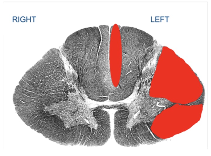 <p>Your patient suffered an injury to the C7 section of the spinal cord. The image below illustrates where the damage (i.e., the lesions) is located by regions covered with red coloring. Note: the image is stained so axons appear dark.</p><p>Which of the following answers best describes the patient's expected sensory changes?</p><p>a) Loss of left arm proprioception</p><p>b) Loss of right arm pain</p><p>c) Loss of right arm proprioception</p><p>d) Loss of left arm pain</p>