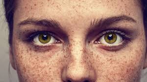 <p>freckles</p>