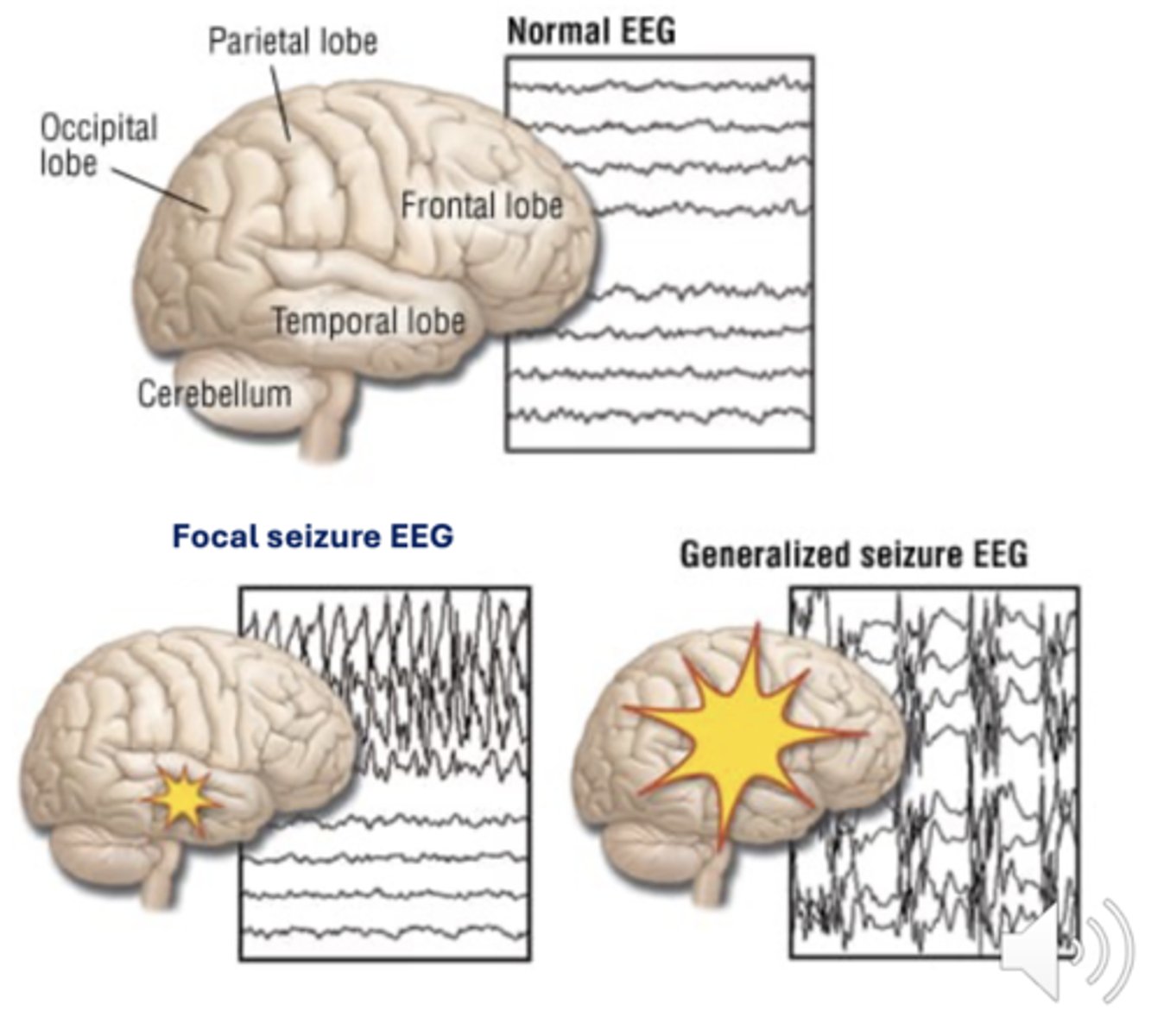 <p>Via electroencephalogram (EEG) seen as spikes and waves</p>