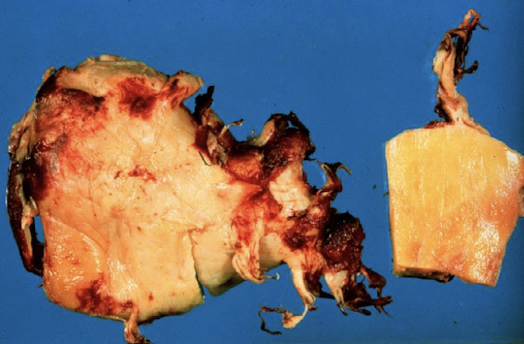 <p>yellow fatty appearance</p>