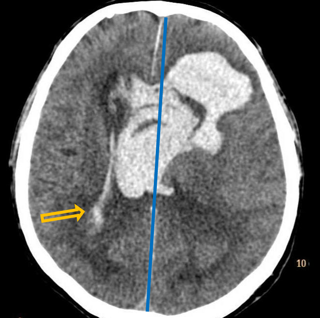 <p>Patient history: sudden onset of altered mental status, loss of consciousness in an elderly patient with untreated hypertension </p><p>Modality: non-enhanced CT, brain window setting (window level: 40 HU; window width: 80 HU) </p><p>Region: brain, axial view Radiologic sign: Large hyperdense area (density: 60-70 HU) extending into the ventricles, slight midline shift to the right and compressed right lateral ventricle due to mass effect (yellow arrow). </p><p>Diagnosis: acute cerebral apoplexy</p>