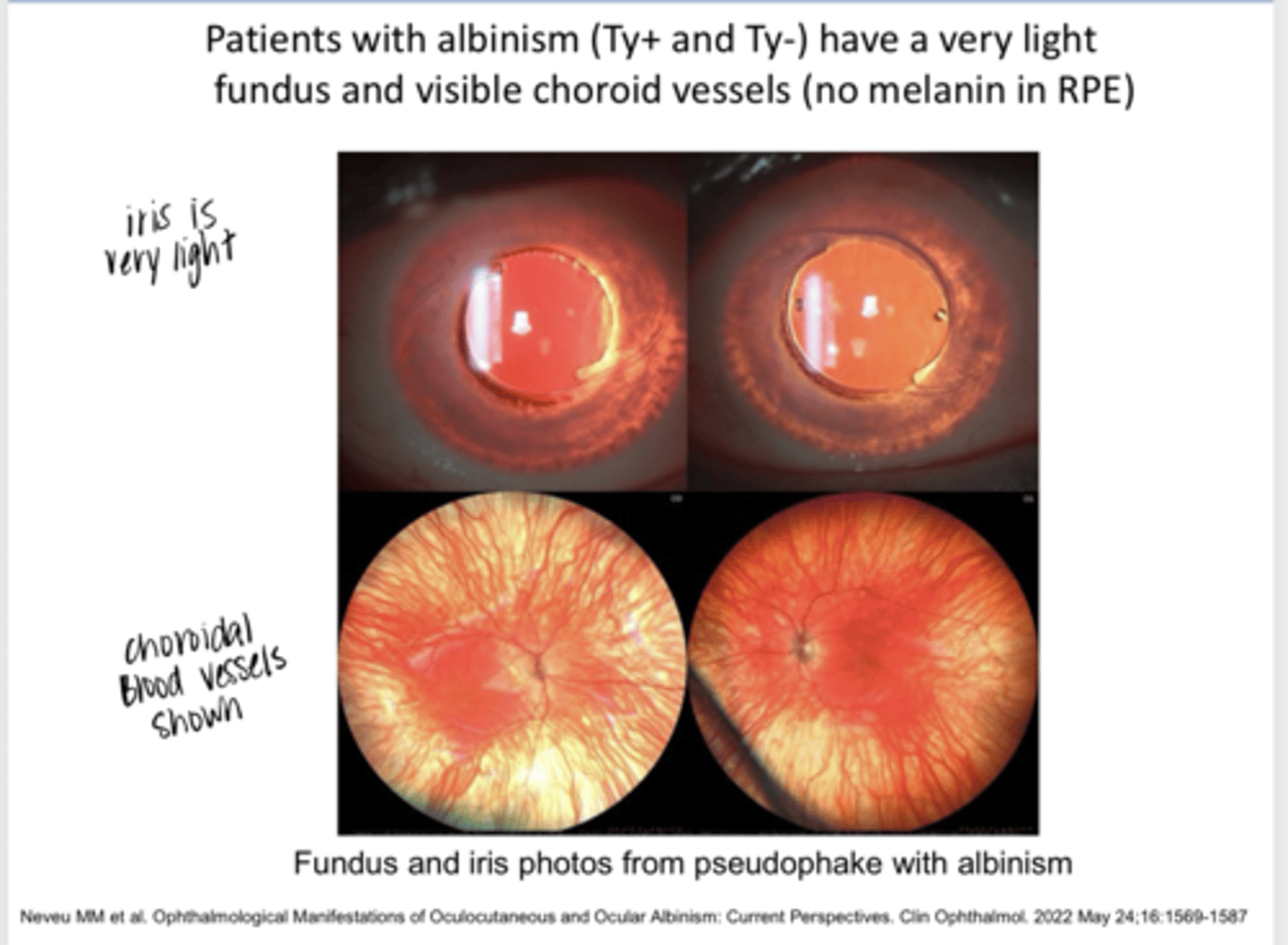 <p>Patients with Albinism Ty(+) or Ty(-) Have a Very Light Fundus &amp; Visible Choroid Vessels D/t No Melanin in the RPE (Pic)</p>