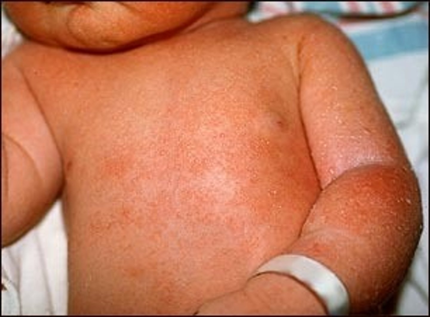 <p>diagnose this:</p><p>2-4 mm erythematous pruritic non- follicular papules</p>