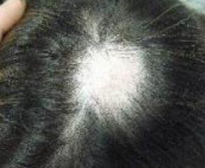 <p>sudden onset of clearly demarcated hair loss, skin smooth without hair, no visible scaling or erythema</p>