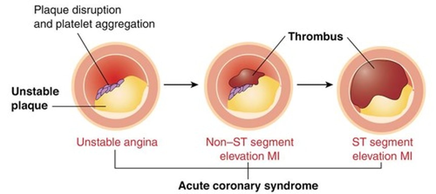 <p>Most severe form of an MI with no blood flow through the CA, is an emergency.</p>