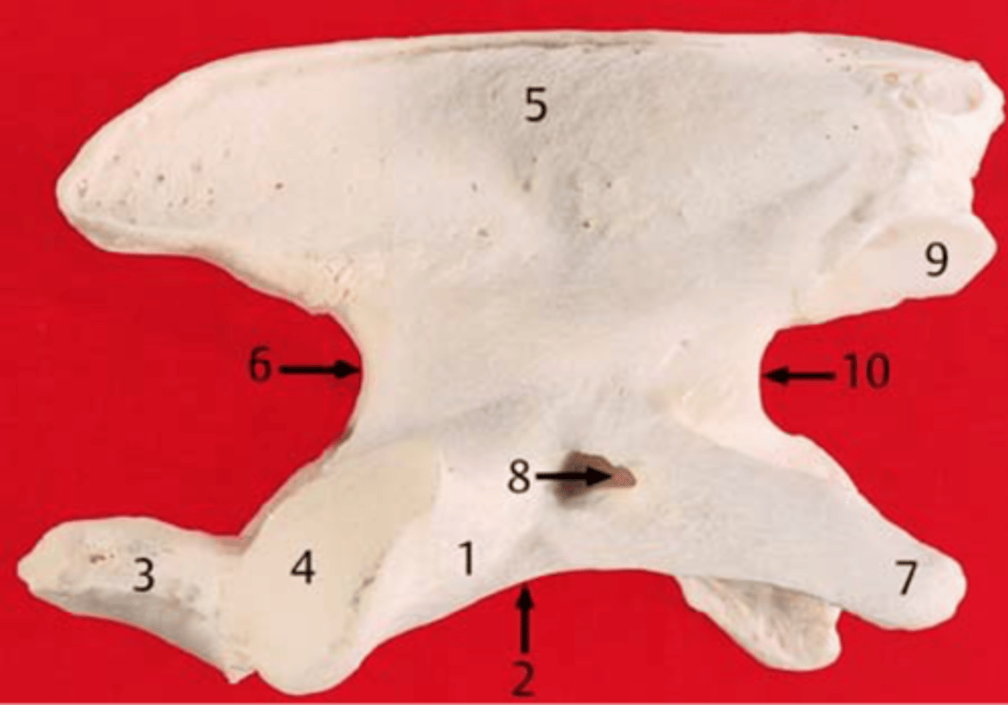 <p>C2 large thick spinous process that overlaps. thick bladelike spinous process that overlaps. has peg like dens on its cranial end that tuck into C1</p>