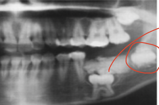 <p>Adenomatoid odontogenic tumor</p>