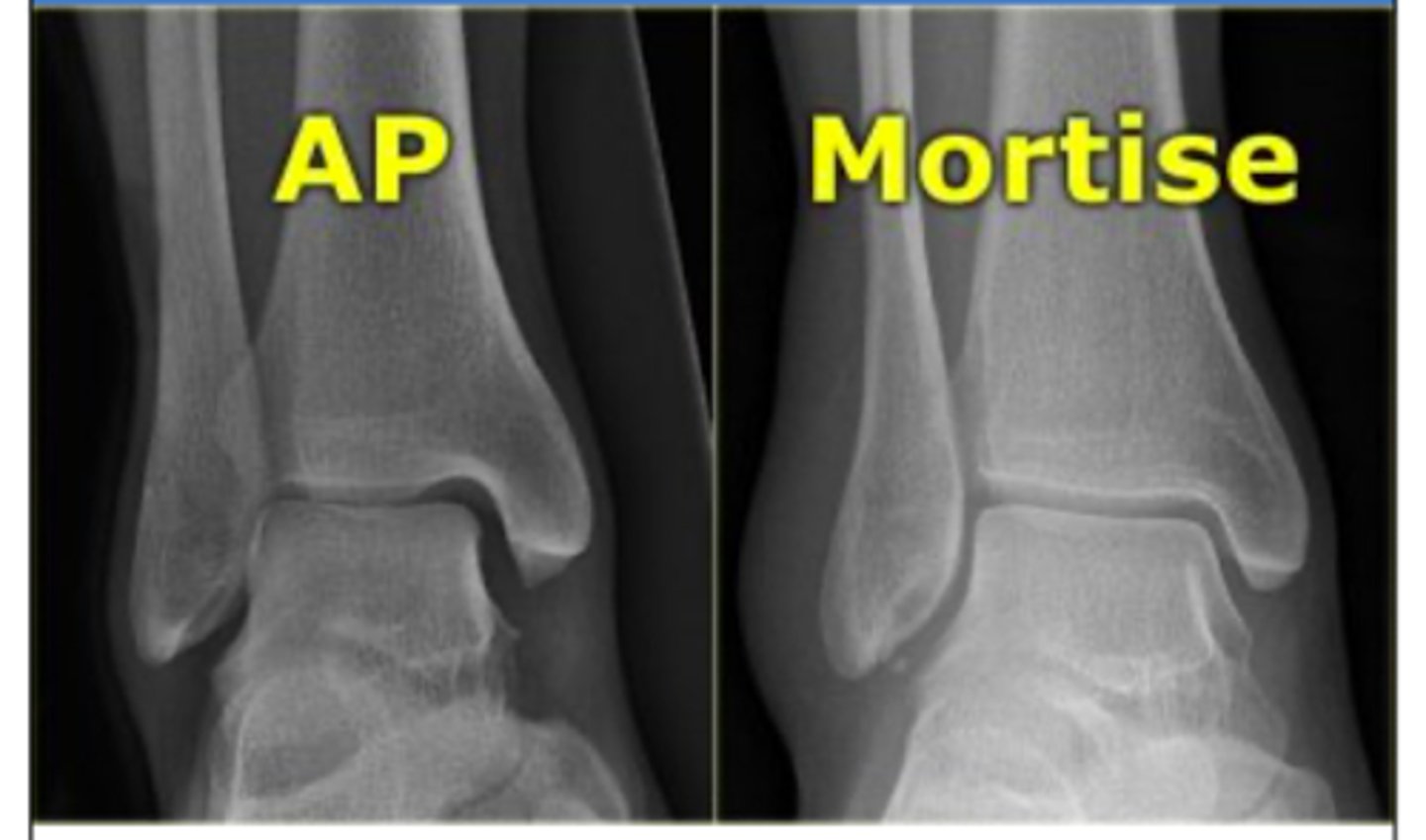 <p>AP → lateral malleolus will overlap </p><p>Mortise → no overlap; will show the mortise joint space (lateral)</p>