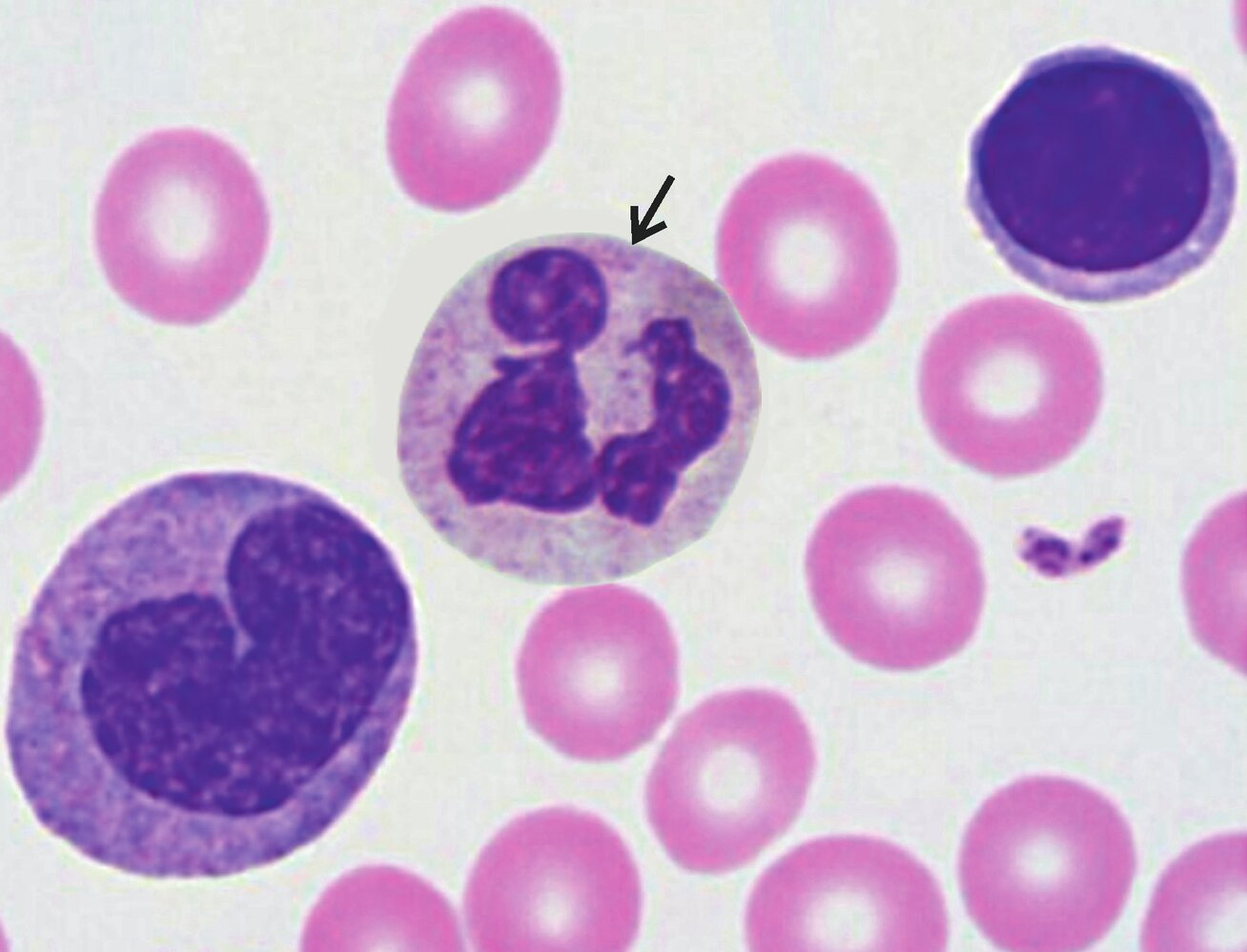 <p>13. In the blood smear shown in the image, a cell is marked with an arrow.</p><p>Under normal (physiological) conditions, how many cells of this type are typically found in one microliter (μL or mm³) of blood in an adult human?</p><p>A. 3 to 5</p><p>B. 100 to 500</p><p>C. 2,000 to 5,000</p><p>D. 200,000 to 300,000</p><p>E. 4 million to 5 million</p>