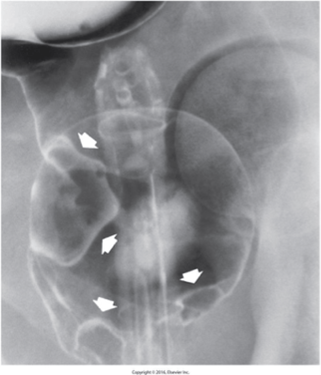 <p>What are hemorrhoids?</p>