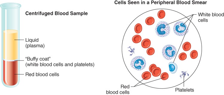 <ul><li><p>the heavier red blood cells settle to the bottom and can thus be measured.</p></li><li><p>The percentage of red blood cells in relationship to the total blood volume is called the hematocrit or packed cell volume.</p><ul><li><p>A normal hematocrit is about 37 to 43 L/L in females and 43 to 49 L/L in males.</p></li></ul></li><li><p>On top of the RBCs is the plasma</p><ul><li><p>the lighter component, approximately 55 percent of the total blood volume</p></li></ul></li><li><p>Between the RBCs and the plasma is a thin layer that is whitish in color and is called the “buffy coat.” </p><ul><li><p>made up of white blood cells and platelets </p></li><li><p>make up roughly 1 percent of the total blood volume.</p></li></ul></li></ul><p></p>