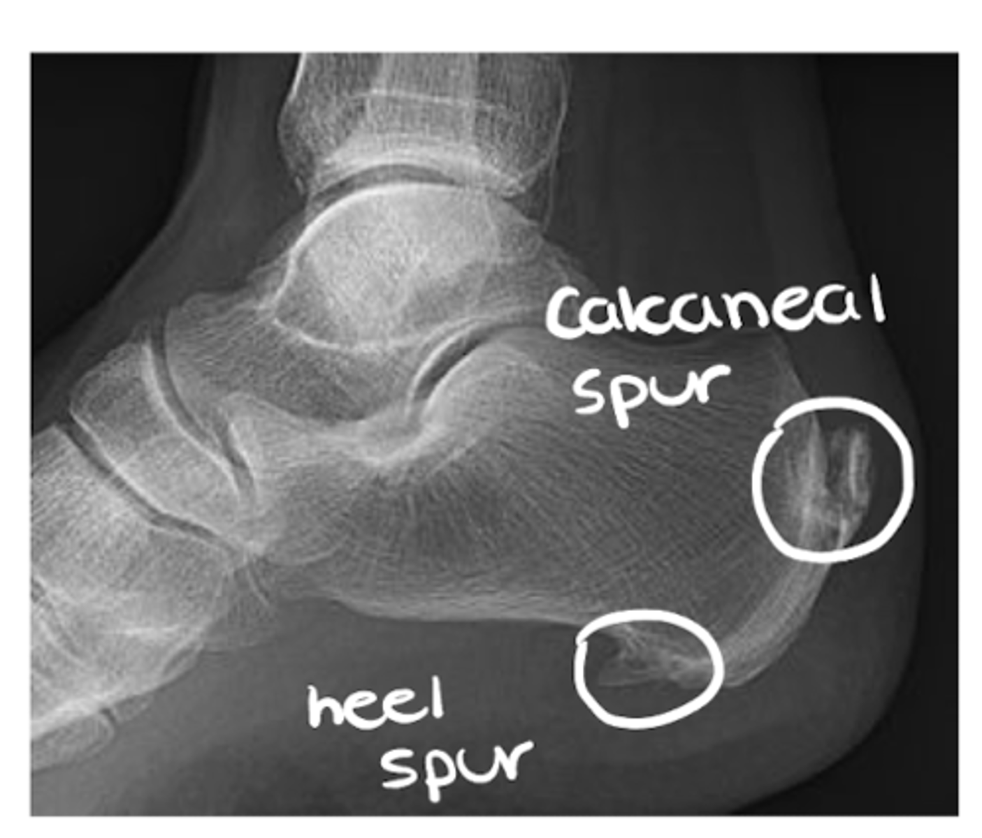 <p>- Irregularities</p><p>- Cortical outline</p><p>- Spurs and osteophytes</p><p>- Fracture</p>