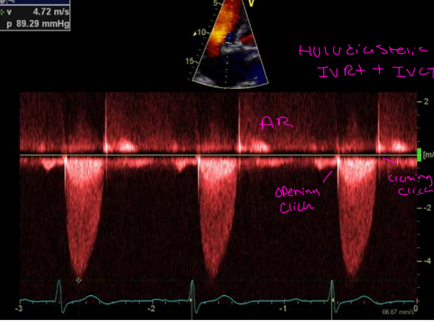 <p>Optimize Doppler signal</p><p>1- Decrease gains and increase</p><p>wall filter</p><p>2 – Adjust Baseline and scale</p><p>3 – Increase sweep speed</p><p>4- Trace TVI of outer edge of</p><p>signal (avoid noise and fine linear</p><p>signals)</p><p>B e s t V i ew s : A p i c a l 3 o r 5 C h am b e r,</p><p>Right Sternal Border, right</p><p>c l a v i c ul a r, and Suparsternal Notch</p>
