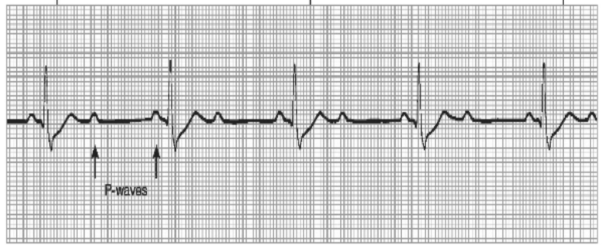 <p>Second Degree Heart block Mobitz Type II</p>