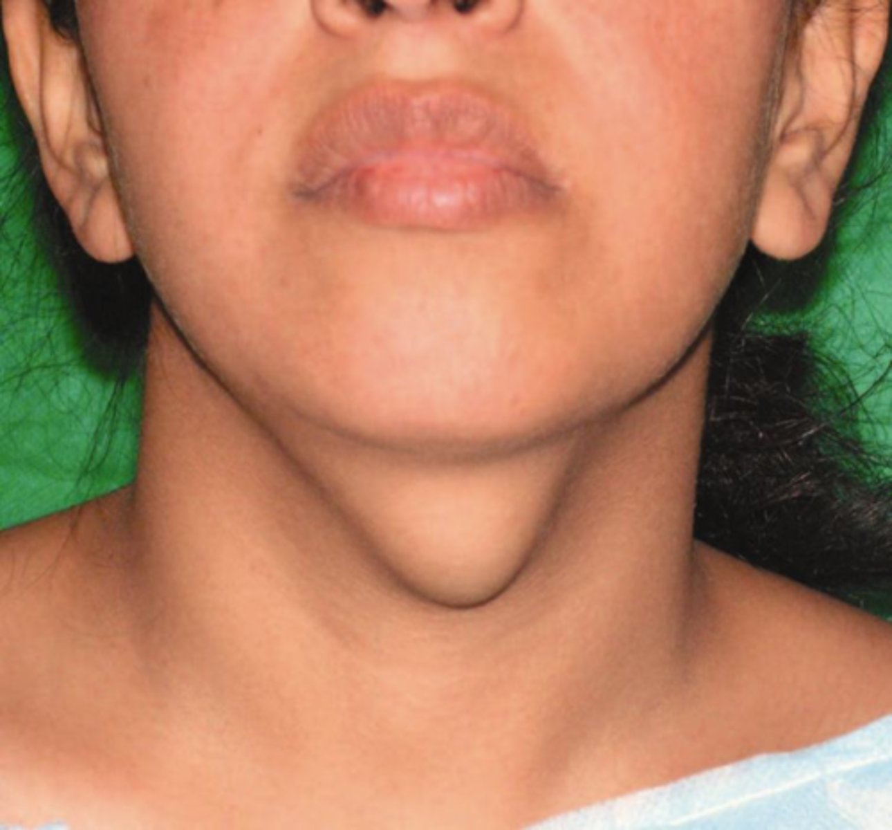 <p>• firm swelling at midline of neck - moves when swallowing</p><p>• dysphagia or difficulty extending tongue</p>