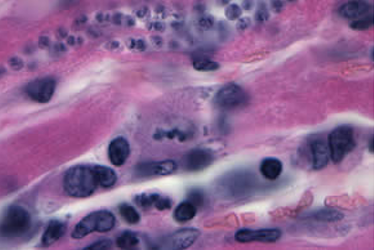 <p>Name: Trypanosoma cruzi</p><p class="p1">Stage: amastigotes in heart tissue (pseudocyst)</p><p class="p1">*Amastigote = round, intracellular, no flagellum.</p><p class="p1">*Little snowmen</p>