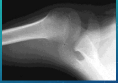 <p><strong>RTC Tears: Treatment </strong></p><p>-1st line → rest, ___, NSAIDs, PT</p><p>-2nd line → ______ injections </p><p>-X-ray → show reduced _____________ space; superior humeral ________ in comparison to the ______ possible </p><p>-Ortho referral → may need _______ if the pt fails conservative treatment within 6 months or they have a complete tear </p>