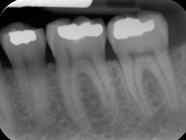 <p>periapical radiographs</p>